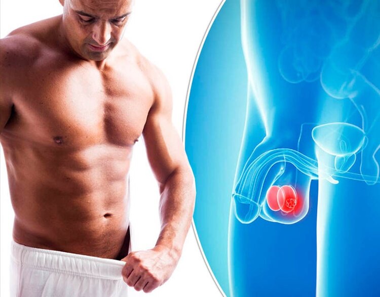Câncer Testicular Câncer Testicular