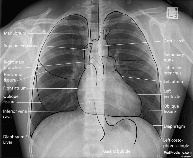 Understandings Basics and How To Read Chest Xray