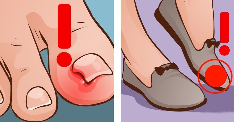 dicas de como eliminar as unhas encravadas