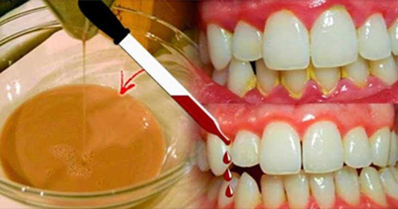 receita caseira para eliminar tartaro