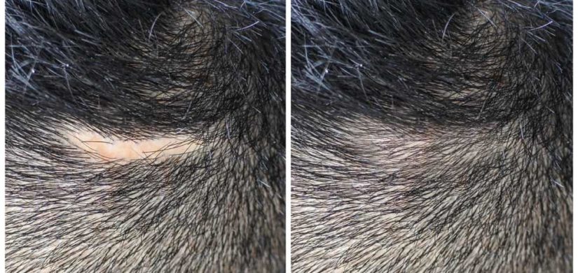 Narbenbehandlung-Kopfhautpigmentierung Permanent-Make-Up
