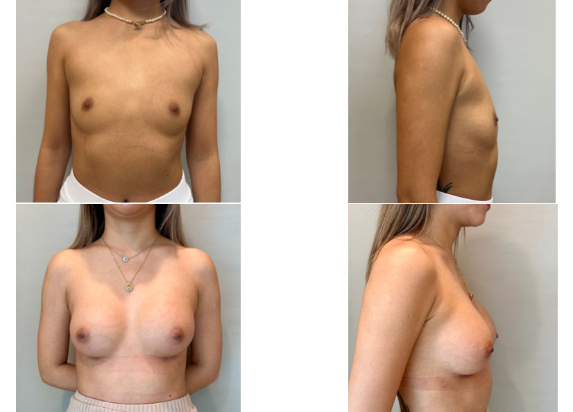 30 Year Old Female Breast Augmentation