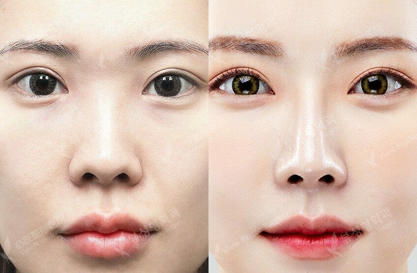 Double Eyelid Surgery Cost In... Eyelid surgery, Double eyelid, Eye surgery