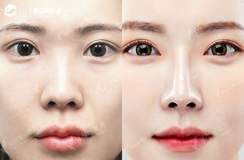Операция двойное веко до и после корея Китаянки до и после пластики Plastic surgery, Cosmetic surgery, Surgery