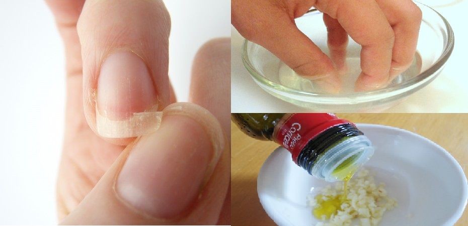 acabar com as unhas quebradiças