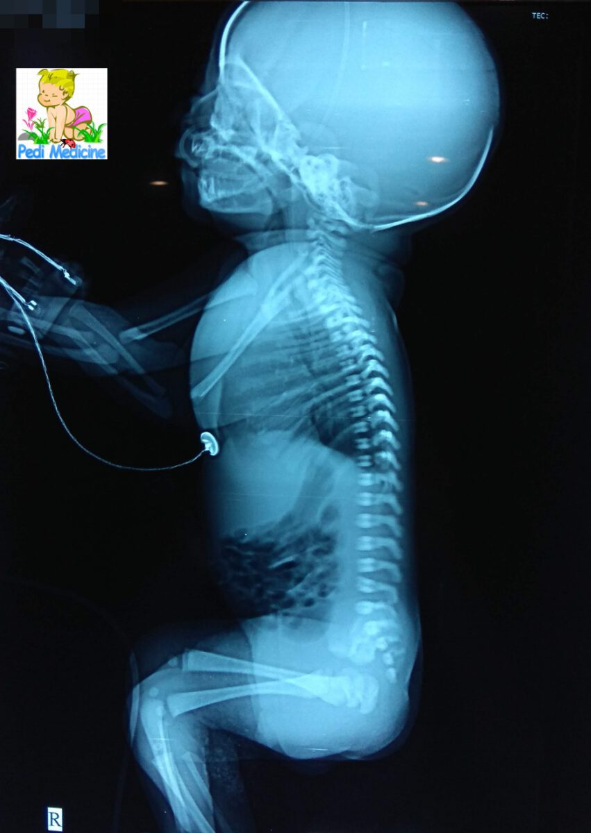 Chest xray lateral view congenital birth defect