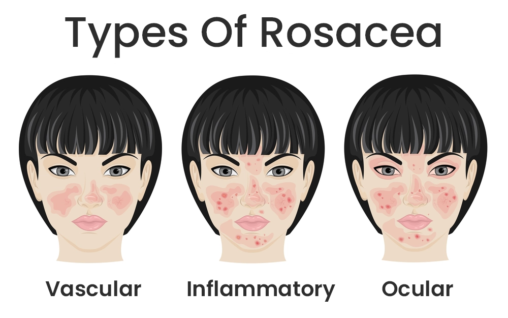 Types Of Rosacea