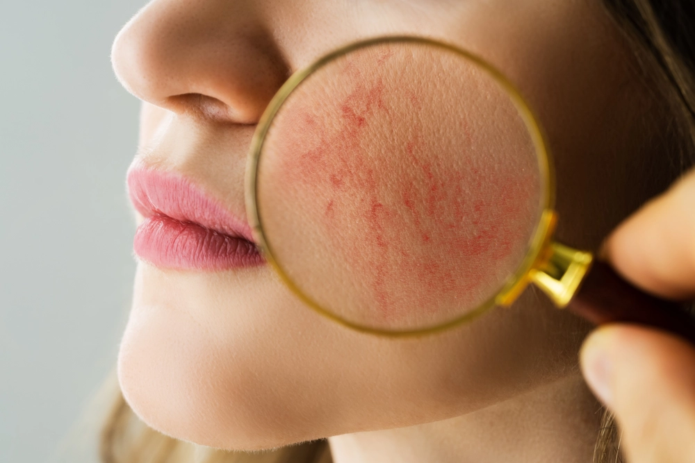 Rosacea Example