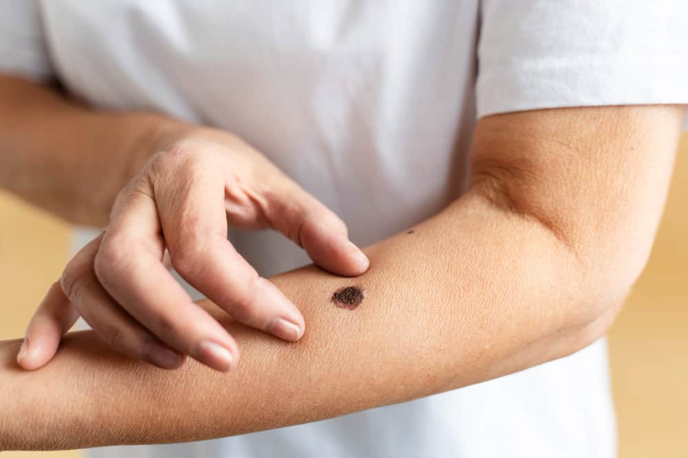 Mole Check