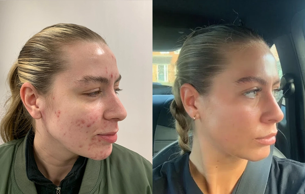 Before and After