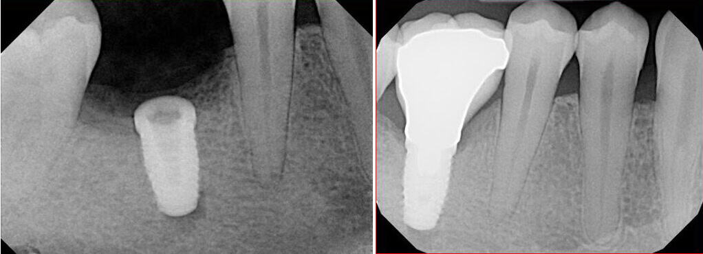 Dental Implants nyc Picture of Before and after x-rays of dental implants and bone graft
