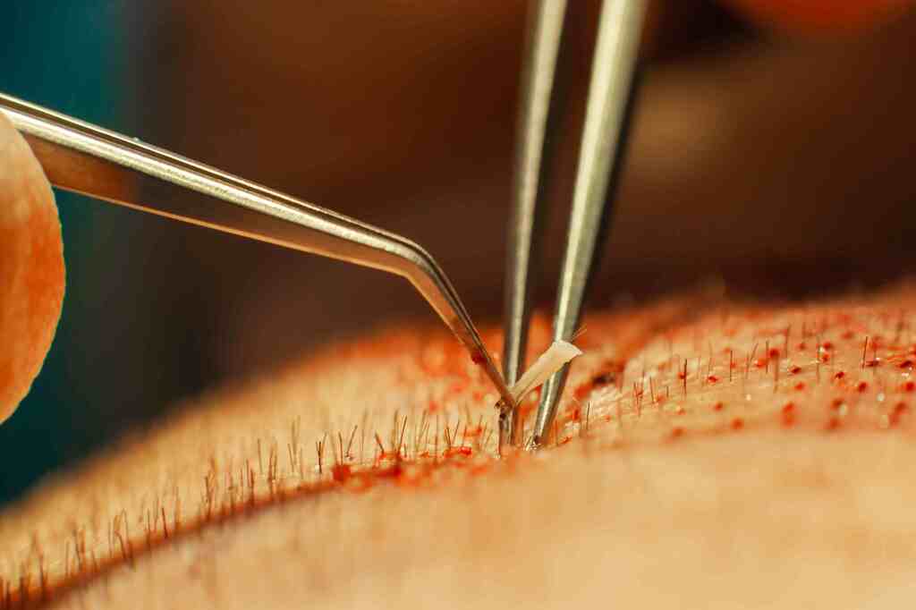 hair-transplant-infection