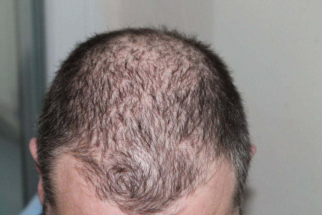 How Does a Hair Transplant Work