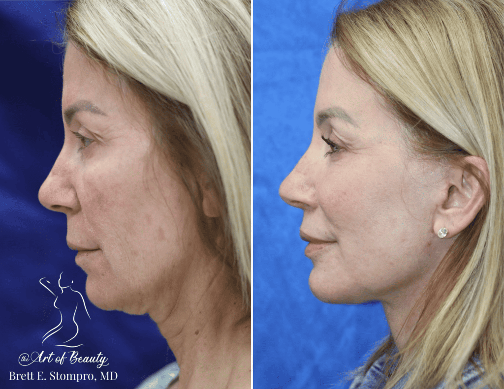 Lower Face & Neck Lift, Endoscopic Brow Lift, Laser Resurfacing, Blepharoplasty, Fat Transfer to the Face, Upper Lip Lift
