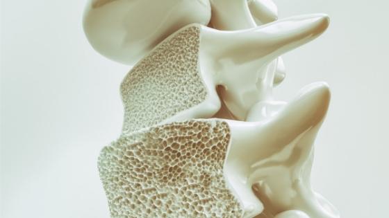 model of spine with osteoporosis -- can osteoporosis be reversed?