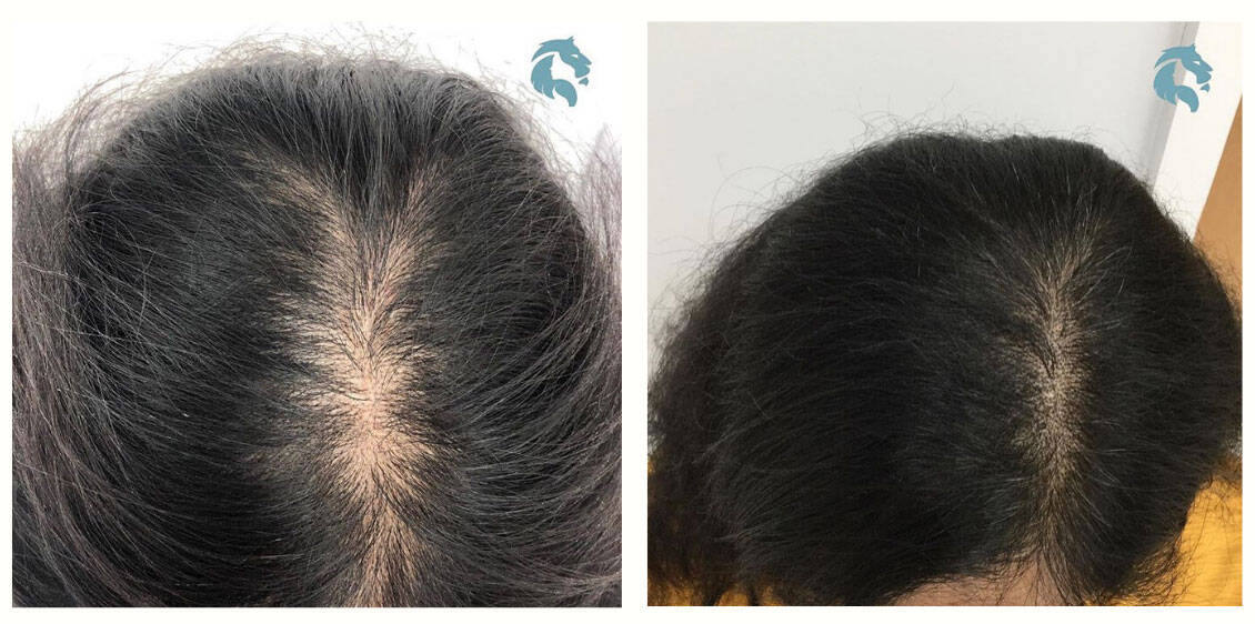 PRP Treatment for Hair Loss: What It Is & How It Works - Aventus Clinic PRP Treatment for Hair Loss: What It Is & How It Works - Aventus Clinic