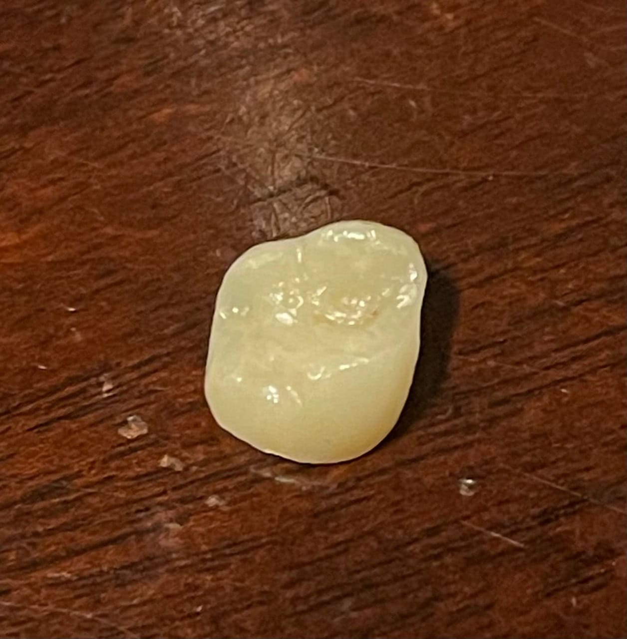 Loose Crown fell out Loose Crown fell out