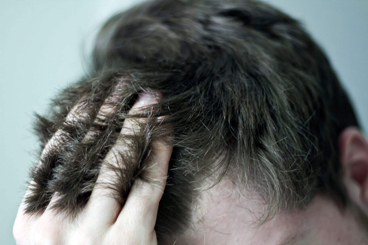 Why-Not-To-Get-a-Hair-Transplant