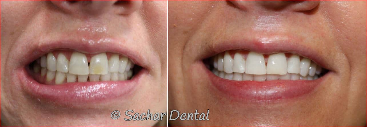 dental whitening bleaching bonding for yellow spot on front tooth NYC cosmetic dentist for Teeth Whitening