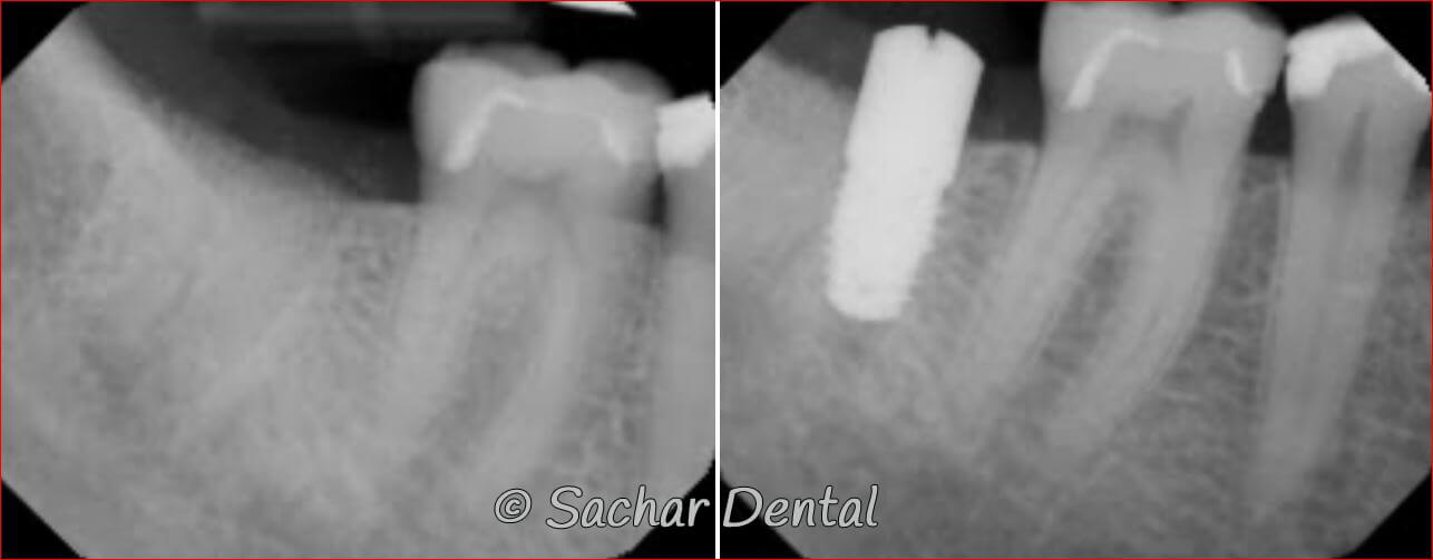 dental implants NYC Dental Implants Manhattan