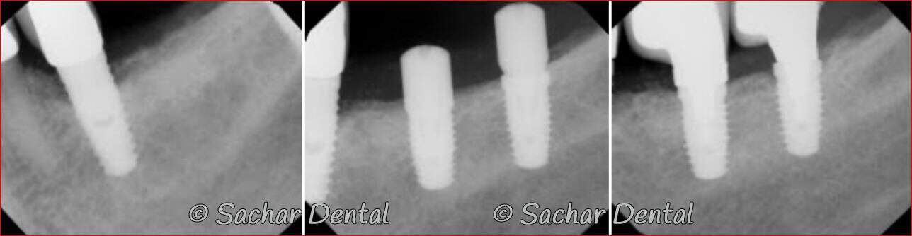 dental implant crown NYC Picture of Before and after x-rays of dental implants