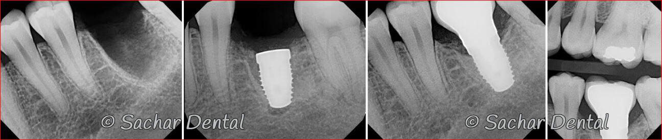Dental implant NYC Picture of Before and after x-rays of tooth extraction and dental implant plus bone graft