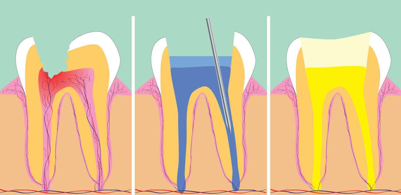 Diagram of Root Canal