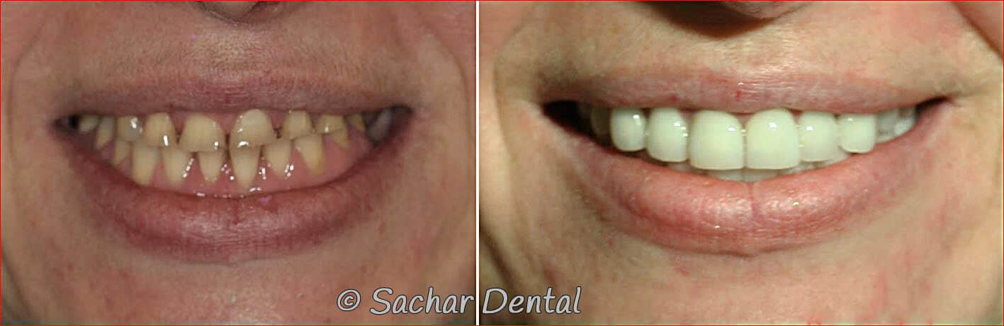 dental implants crowns full mouth reconstruction nyc Cosmetic Dentistry NYC for complex cases