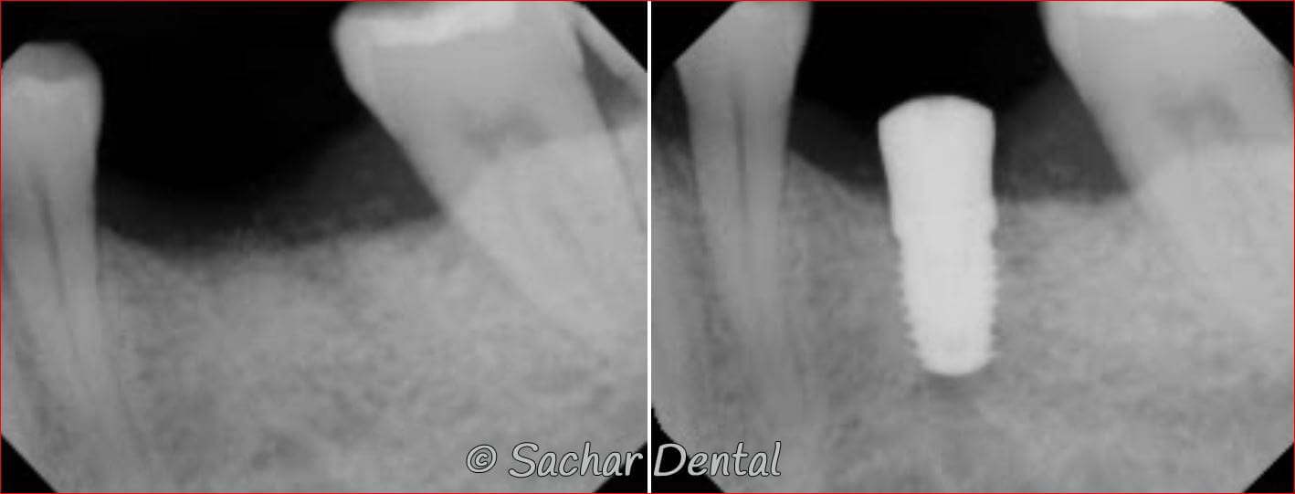 dental implant xray nyc All on 4 Dental Implants NYC