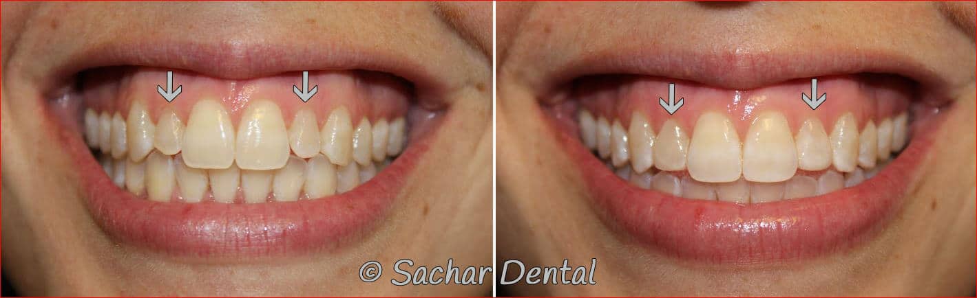 dental bonding nyc Top NYC cosnetic dentist for resin veneers. Before and after pictures of resin bondings