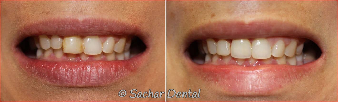 dental bonding porcelain veneers Top NYC Cosmetic Dentists for Veneers and more