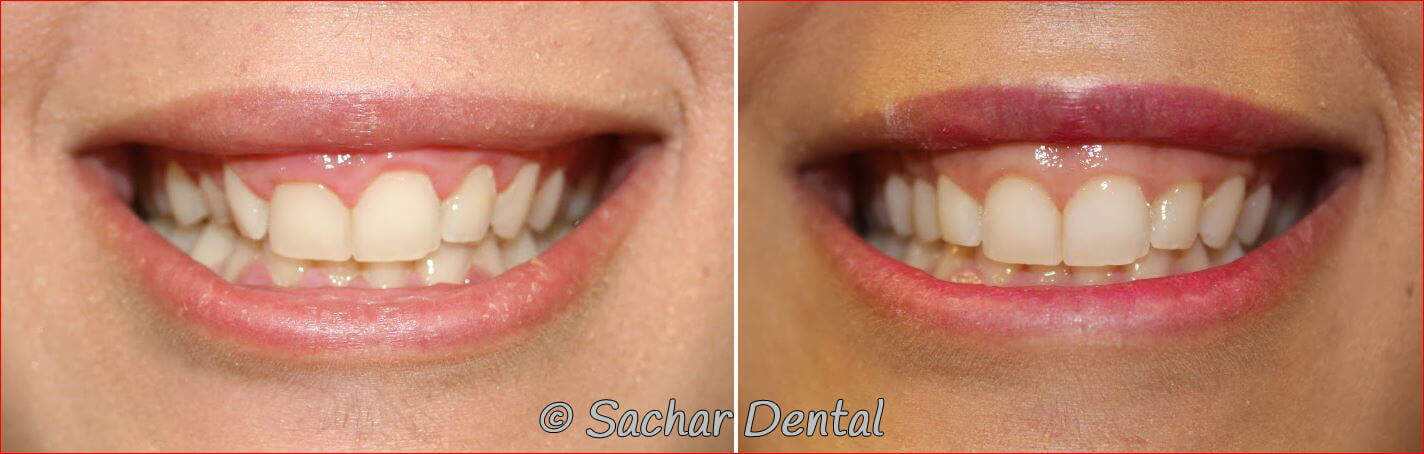porcelain veneers gum surgery gum lift nyc NYC cosmetic dentist doing gum lifts. Before and after pictures of cosmetic gum lifts and porcelain veneers