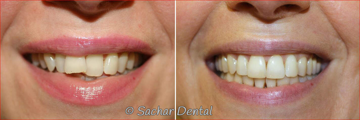detnal bonding Top Invisalign Dentist NYC