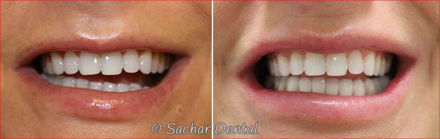 NYC porcelain veneers bridge bonding V02 Best NYC cosmetic dentist. Before and after pictures of porcelain veneers and a 3 tooth bridge