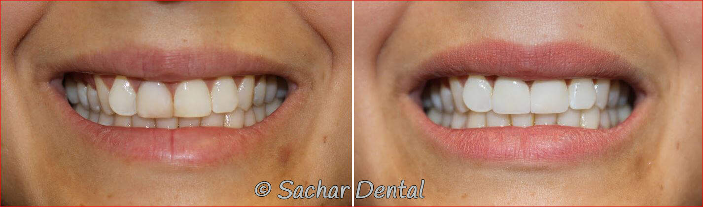 porcelain veneers crown nyc NYC cosmetic dentistry. Before and after pictures of porcelain crowns