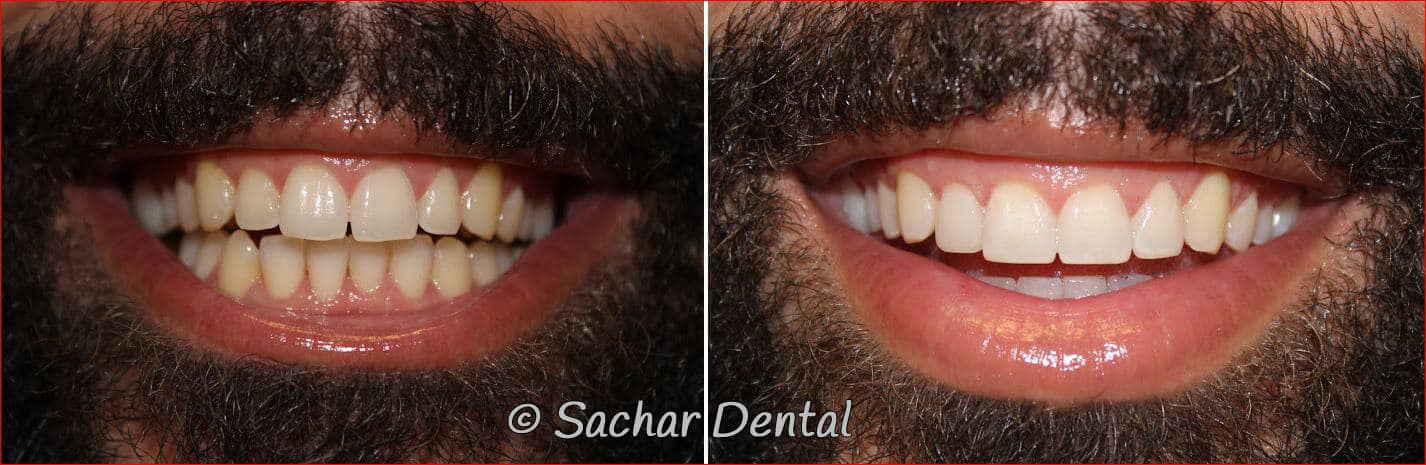 porcelain veneers dental bondings nyc Before and after pictures of resin bonding veneers