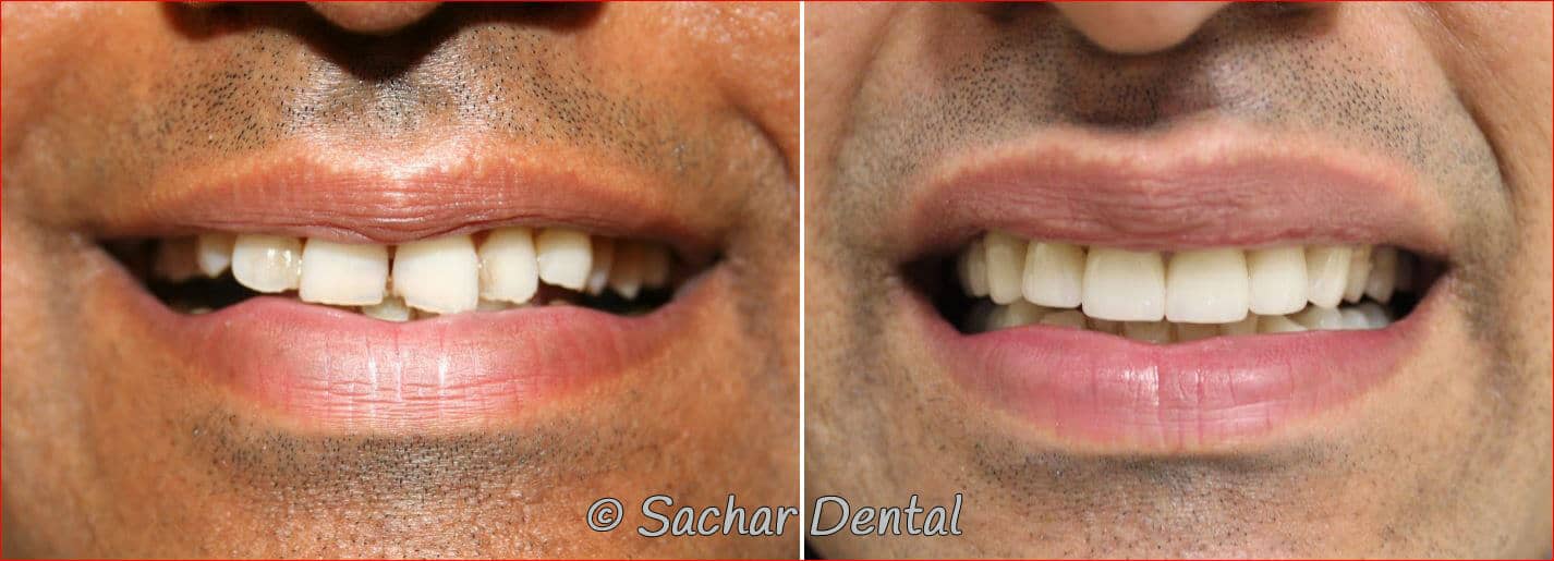 dental crowns implants Cosmetic Dentistry NYC for crowns and veneers