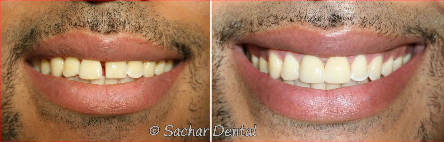 crown veneer dental bonding Top Manhattan Cosmetic Dentists for natural looking crowns