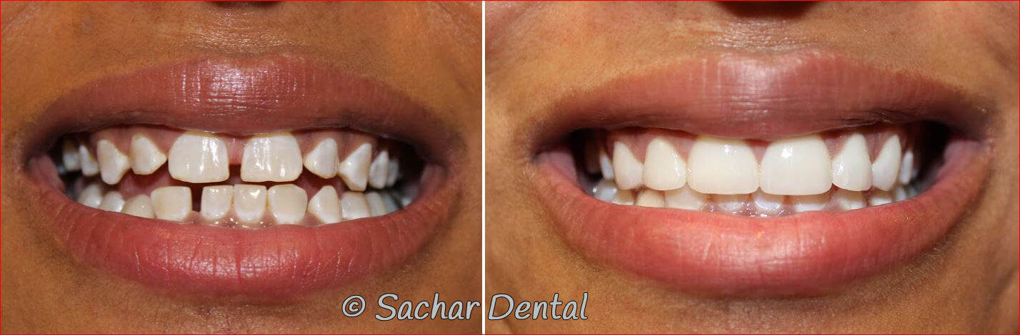 porcelain veneers dental bonding Top NYC Cosmetic Dentist for Porcelain Veneers