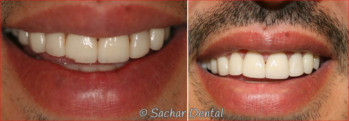 Chipped broken veneer replacment repair Best cosmetic dentist NYC. Before and after pictures of chipped porcelain veneer