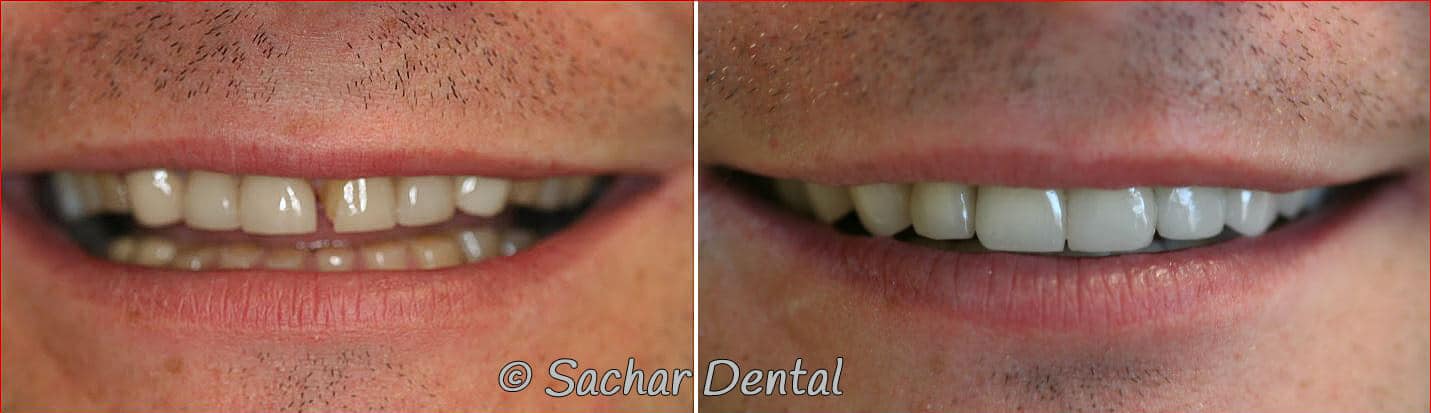 Crowns dental imlants before and after Best Cosmetic Dentist in NYC for full mouth reconstruction