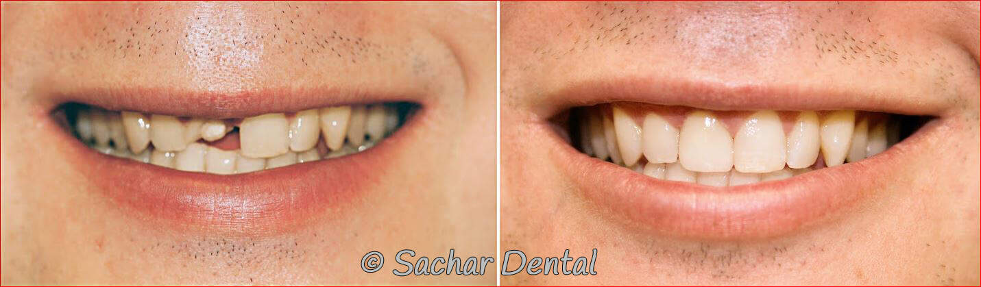 tooth crown dentist nyc Before and after pictures Cosmetic Dentistry NYC