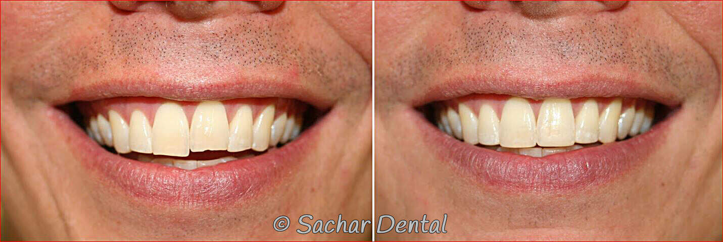 tooth bonding nyc Cosmetic dentist NYC for veneers and bondings. Before and after pictures of resin bonding of chipped teeth