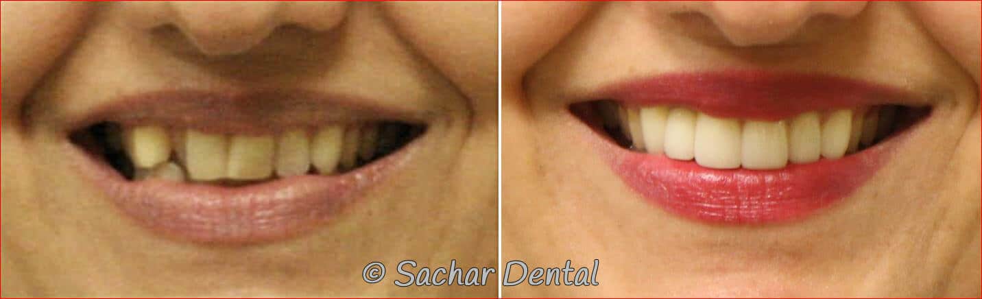porcelain Veneers front teeth Cosmetic Dentistry NYC for all your cosmetic concerns