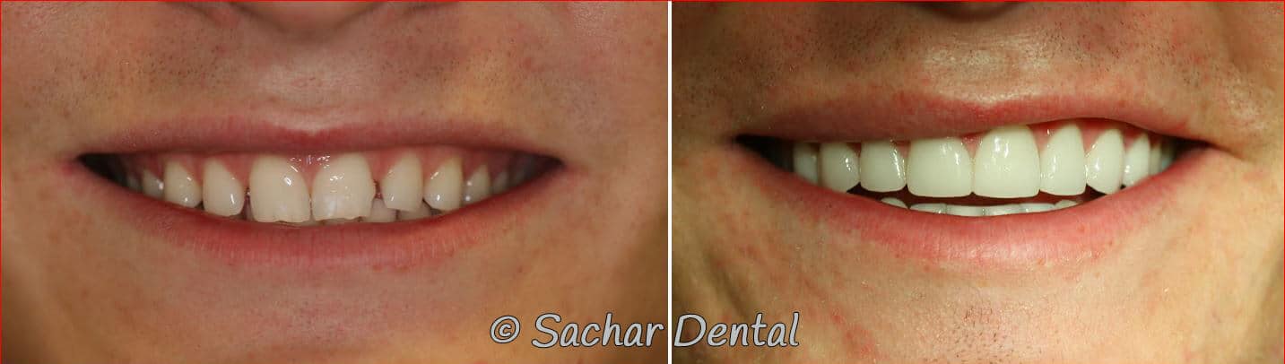 porcelain veneers Top rated NYC cosmetic dentist for Porcelain Veneers