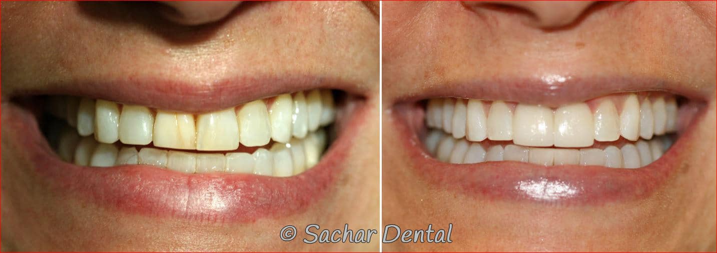 porcelain veneers for front teeth nyc Best NYC Cosmetic Dentist for porcelain Crowns and veneers