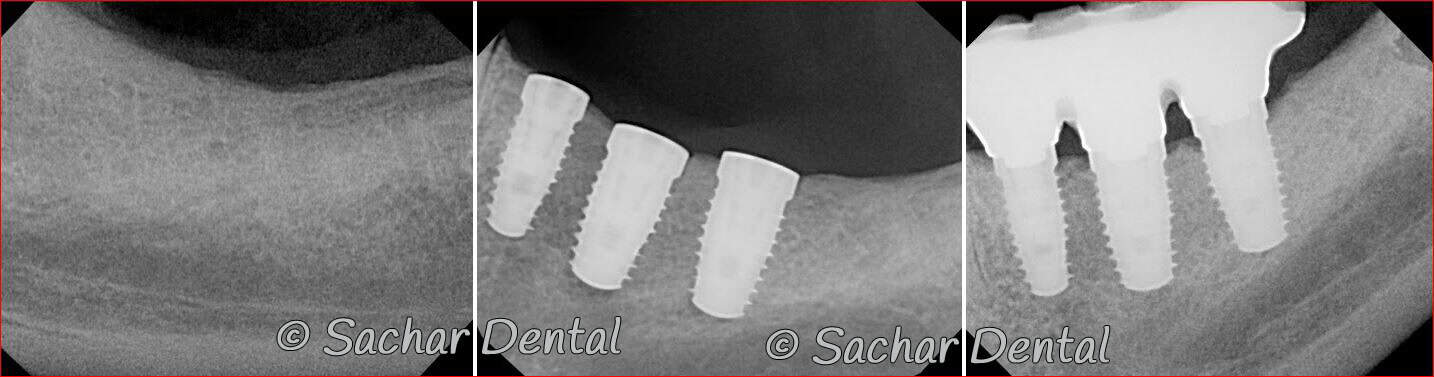 dental implant abutments crowns Picture of Before and after x-rays of bone graft plus dental implant