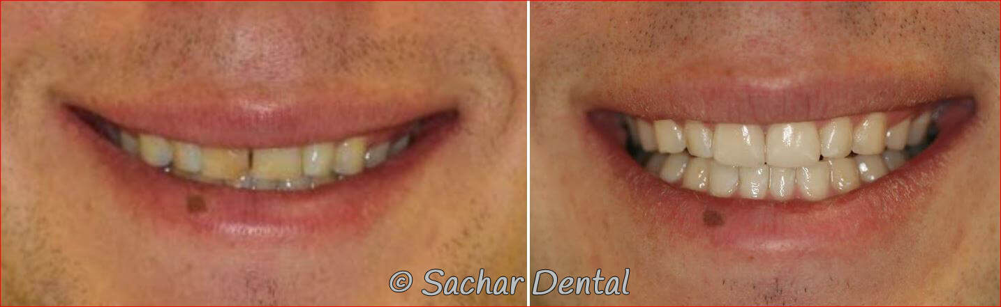 porcelain crown veneer nyc NYC cosmetic dentist for veneers and crowns. Before and after pictures of porcelain crown and porcelain veneer