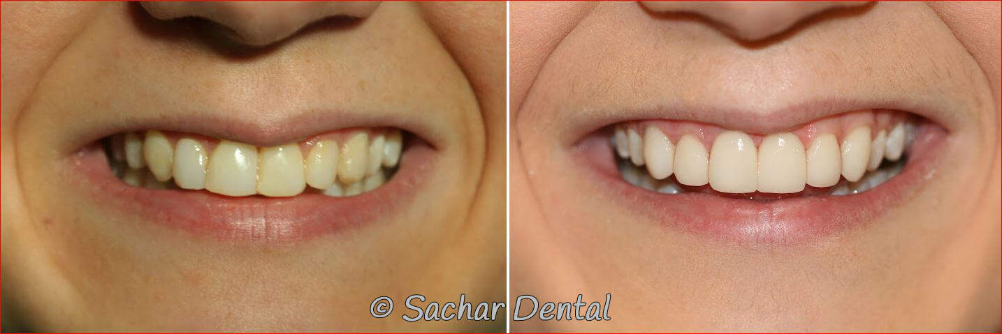porcelain veneers Top rated NYC cosmetic dentist. Before and after pictures of porcelain veneers