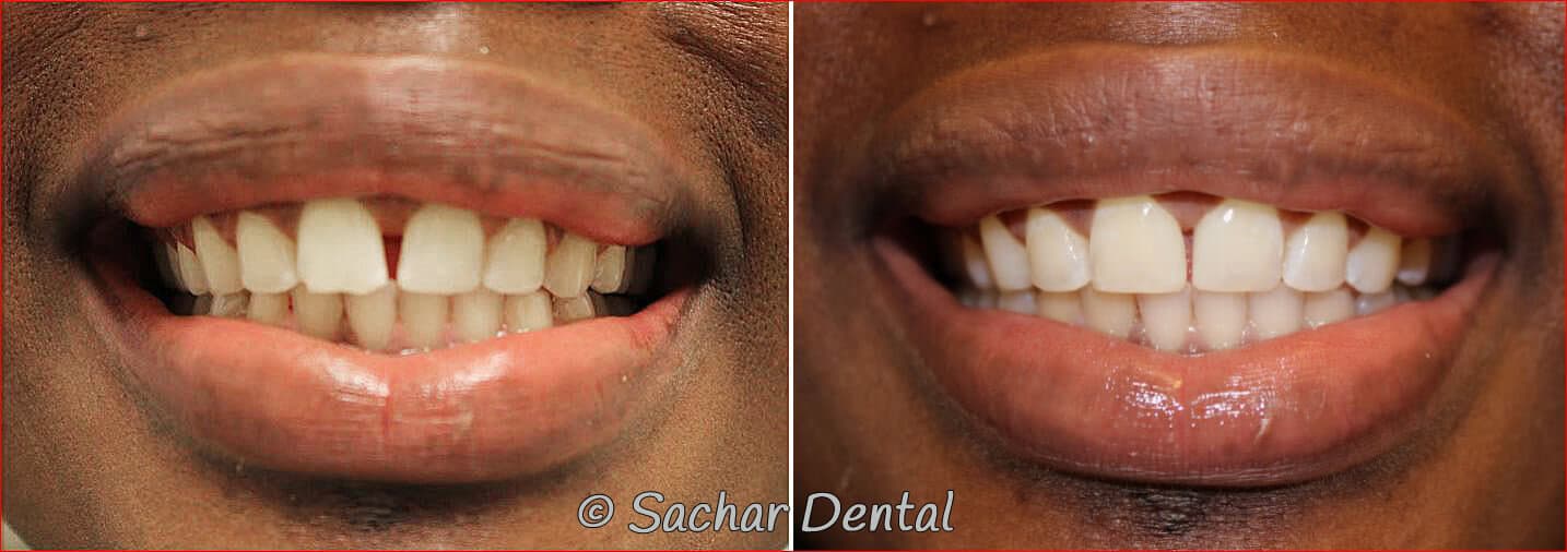 bonding dentist nyc before and after pictures and resin bonding veneers